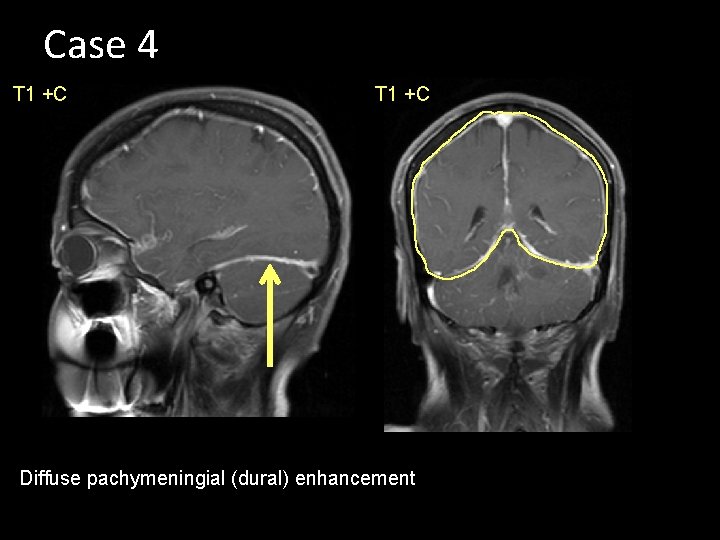 Case 4 T 1 +C Diffuse pachymeningial (dural) enhancement 