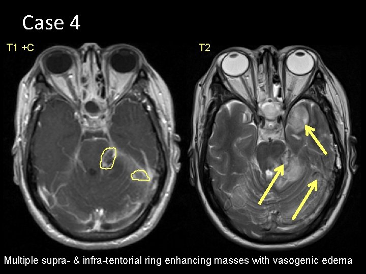 Case 4 T 1 +C T 2 Multiple supra- & infra-tentorial ring enhancing masses
