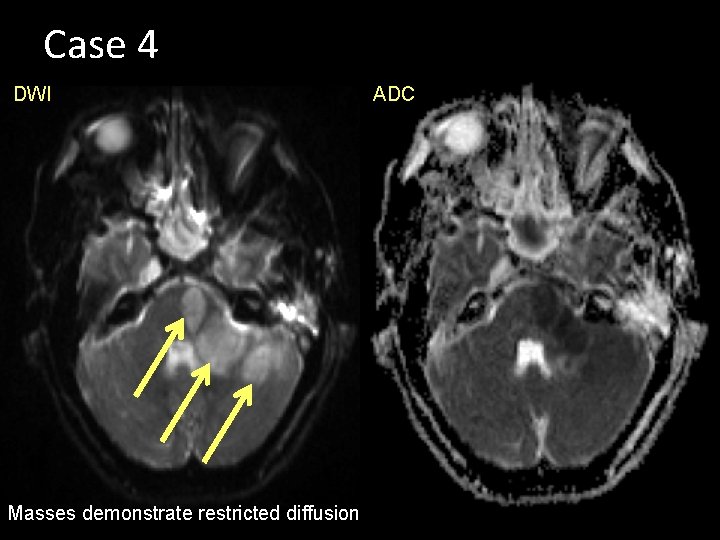 Case 4 DWI Masses demonstrate restricted diffusion ADC 