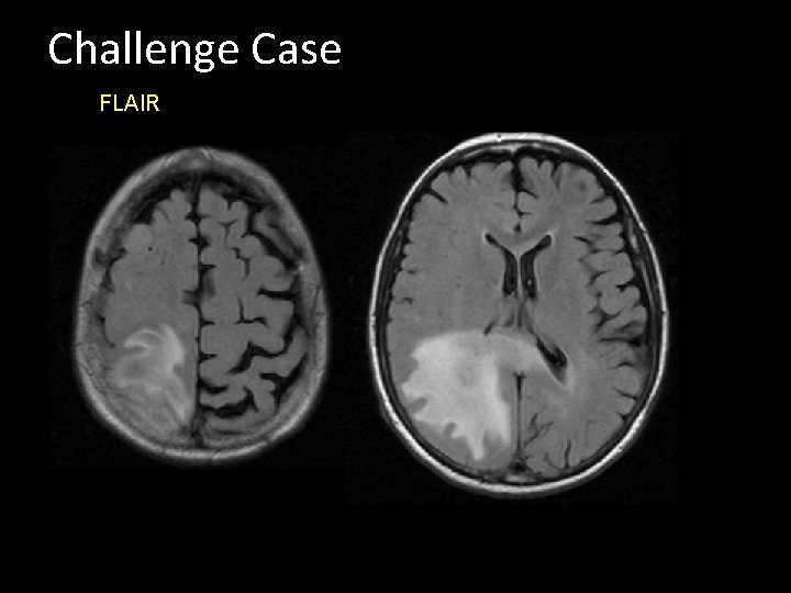 Challenge Case FLAIR 