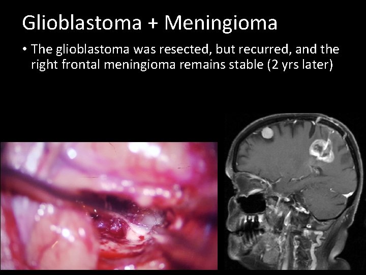 Glioblastoma + Meningioma • The glioblastoma was resected, but recurred, and the right frontal