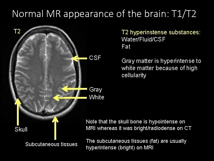 Normal MR appearance of the brain: T 1/T 2 T 2 hyperinstense substances: Water/Fluid/CSF