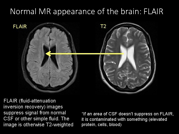 Normal MR appearance of the brain: FLAIR T 2 FLAIR * * FLAIR (fluid-attenuation