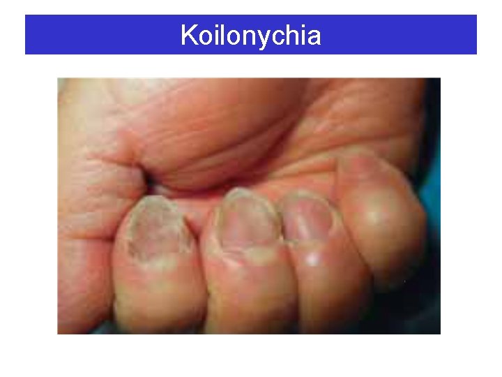 Koilonychia 