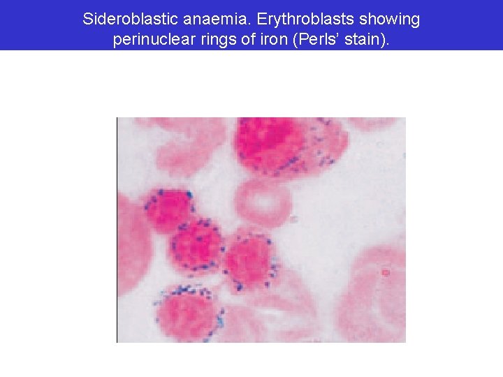 Sideroblastic anaemia. Erythroblasts showing perinuclear rings of iron (Perls’ stain). 