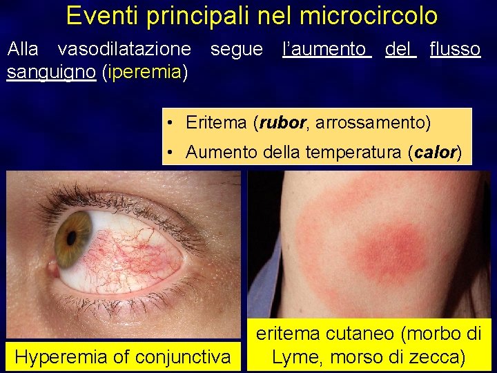 Eventi principali nel microcircolo Alla vasodilatazione segue l’aumento del flusso sanguigno (iperemia) • Eritema