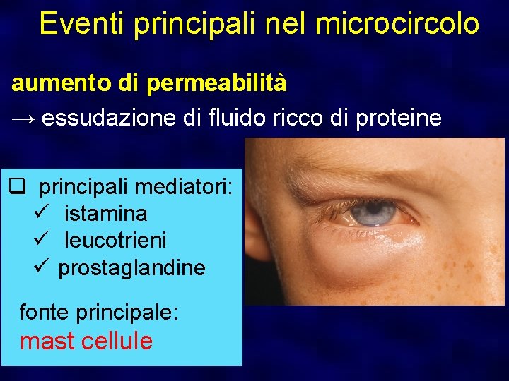 Eventi principali nel microcircolo aumento di permeabilità → essudazione di fluido ricco di proteine