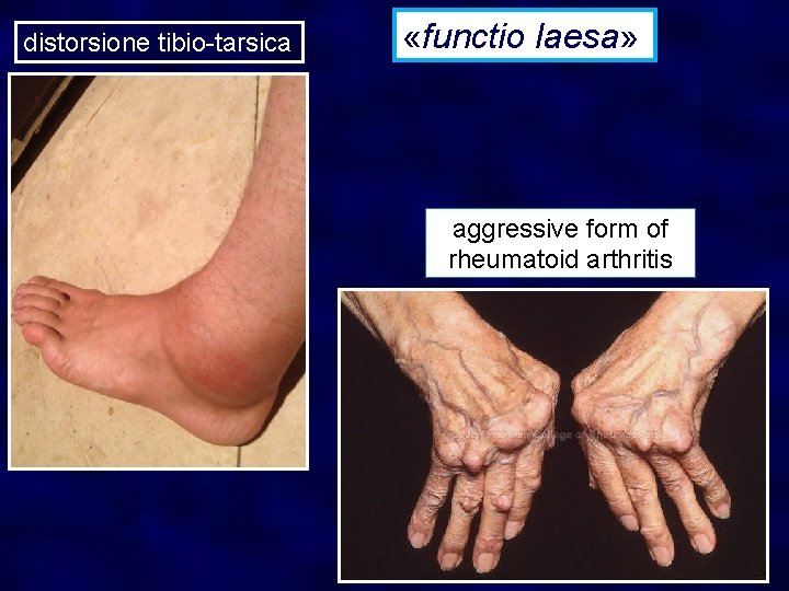 distorsione tibio-tarsica «functio laesa» aggressive form of rheumatoid arthritis 