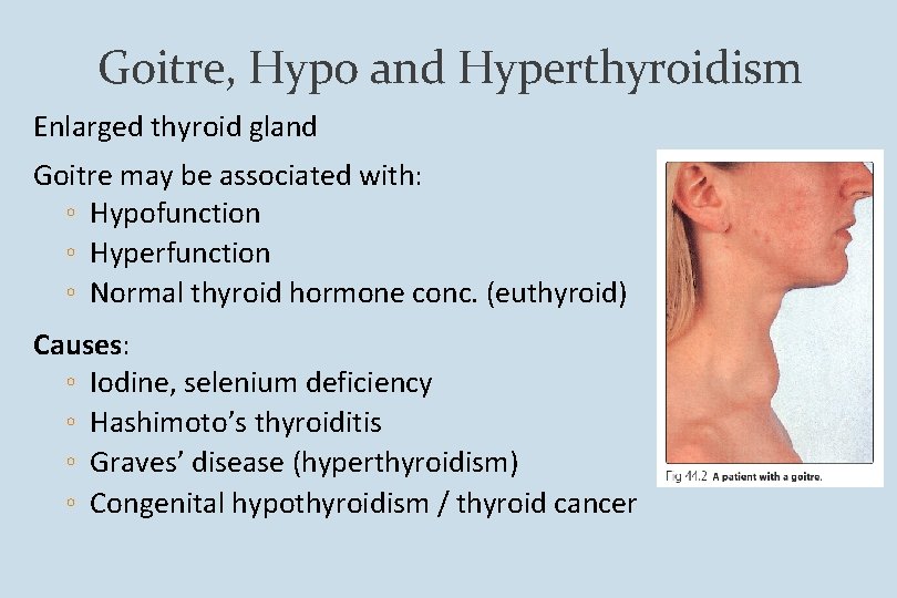 Goitre, Hypo and Hyperthyroidism Enlarged thyroid gland Goitre may be associated with: ◦ Hypofunction