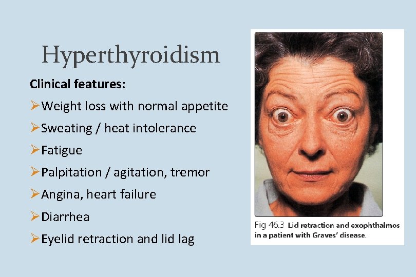 Hyperthyroidism Clinical features: ØWeight loss with normal appetite ØSweating / heat intolerance ØFatigue ØPalpitation