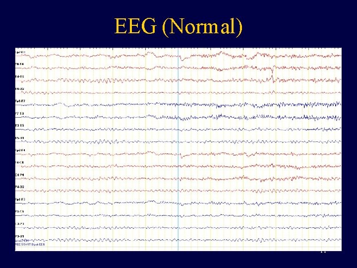 EEG (Normal) 11 