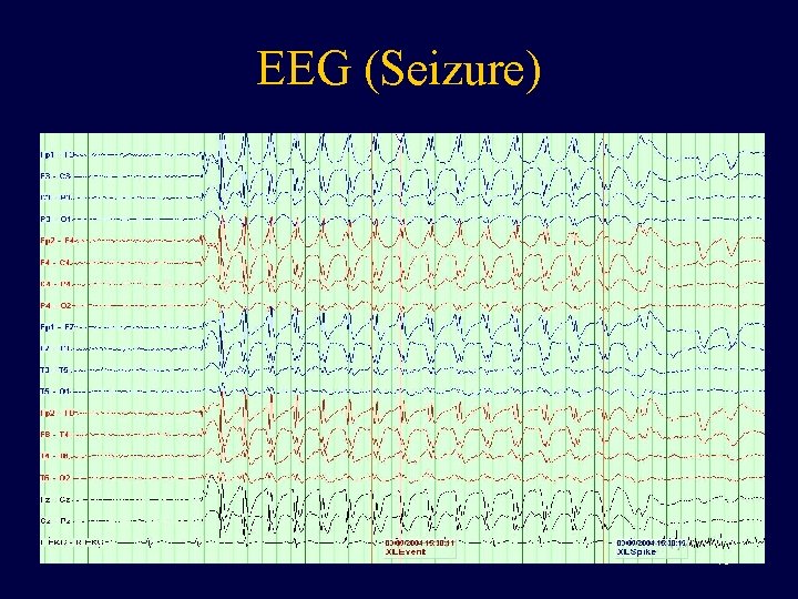 EEG (Seizure) 40 