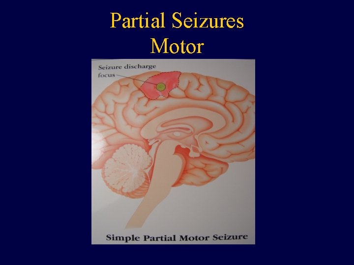 Partial Seizures Motor 