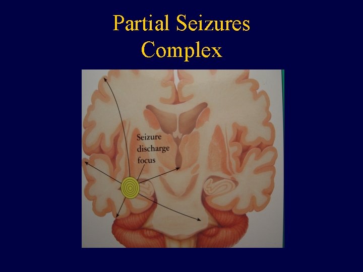 Partial Seizures Complex 