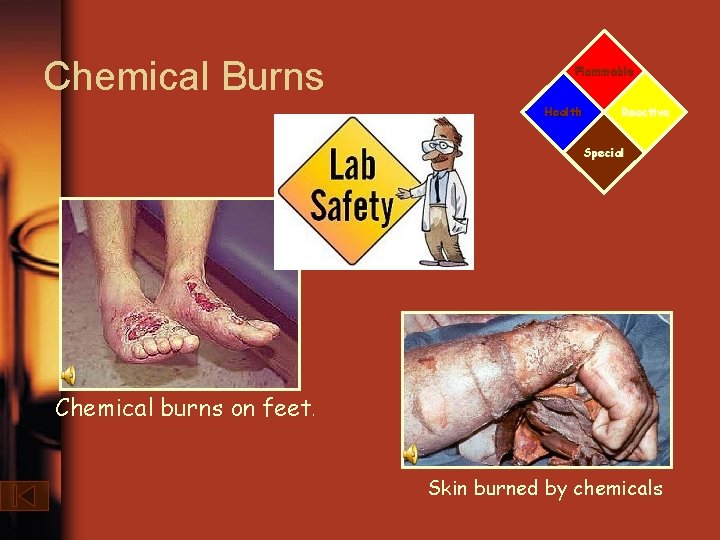 Chemical Burns Flammable Health Reactive Special Chemical burns on feet. Skin burned by chemicals