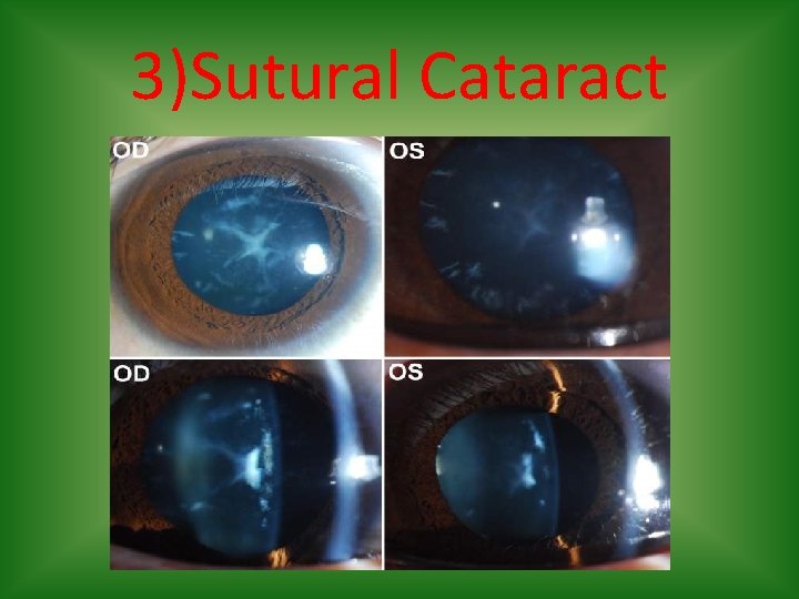 3)Sutural Cataract 