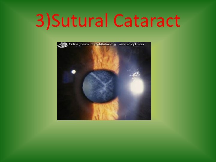 3)Sutural Cataract 