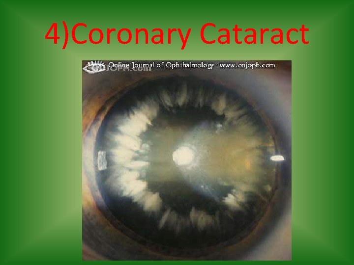 4)Coronary Cataract 