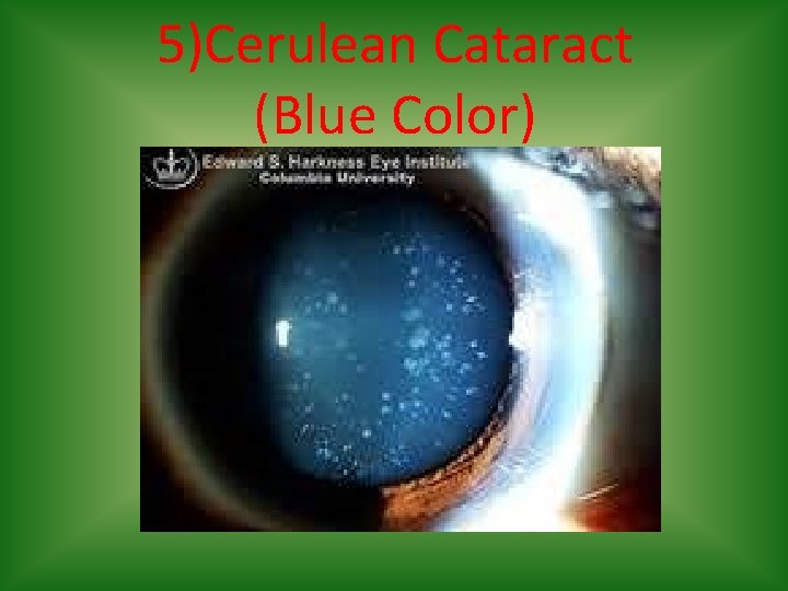 5)Cerulean Cataract (Blue Color) 