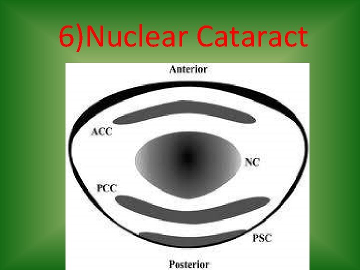 6)Nuclear Cataract 