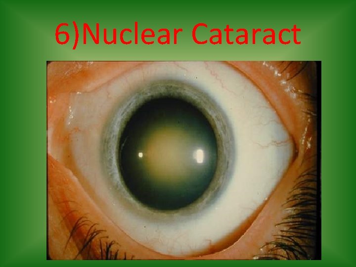 6)Nuclear Cataract 
