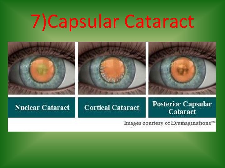 7)Capsular Cataract 