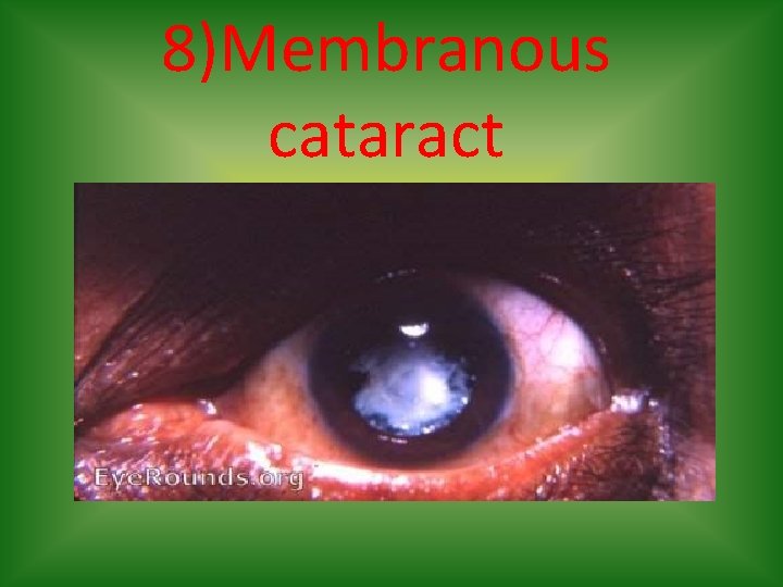 8)Membranous cataract 