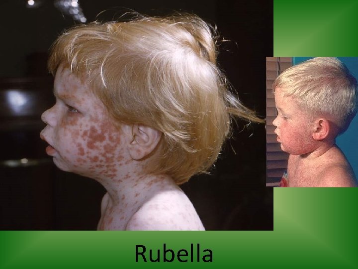 Rubella 