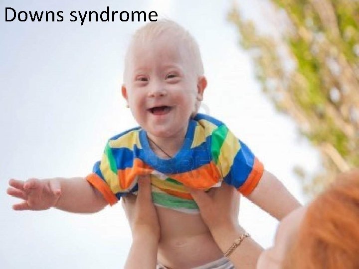 Downs syndrome 
