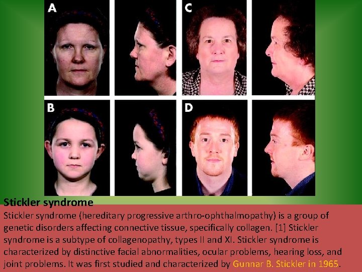 Stickler syndrome (hereditary progressive arthro-ophthalmopathy) is a group of genetic disorders affecting connective tissue,
