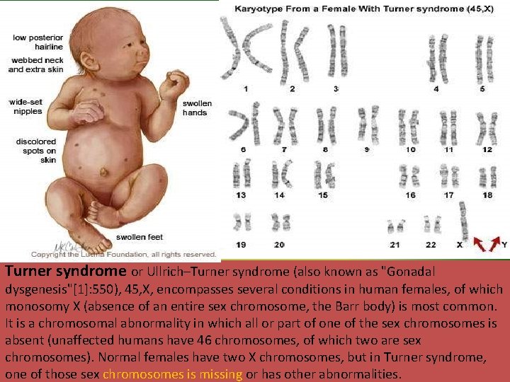 Turner syndrome or Ullrich–Turner syndrome (also known as "Gonadal dysgenesis"[1]: 550), 45, X, encompasses