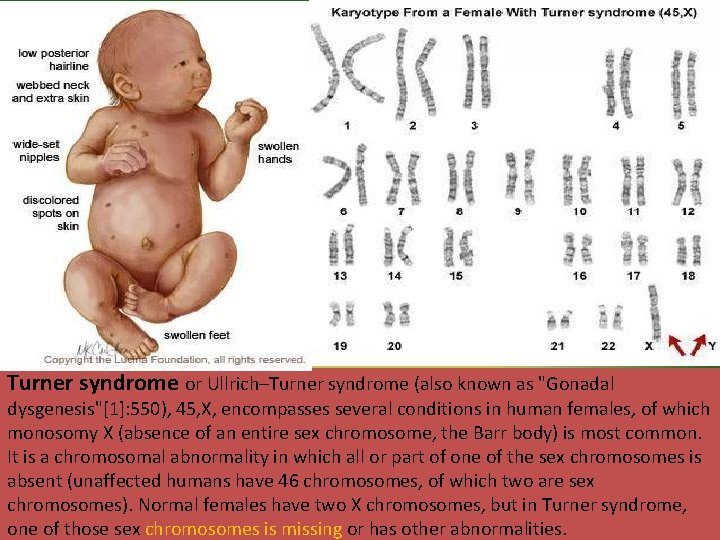 Turner syndrome or Ullrich–Turner syndrome (also known as "Gonadal dysgenesis"[1]: 550), 45, X, encompasses