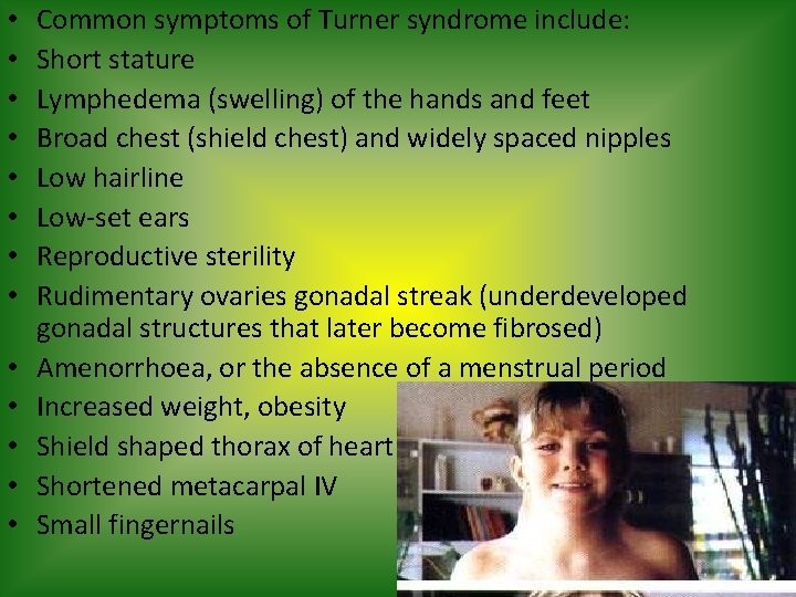  • • • • Common symptoms of Turner syndrome include: Short stature Lymphedema