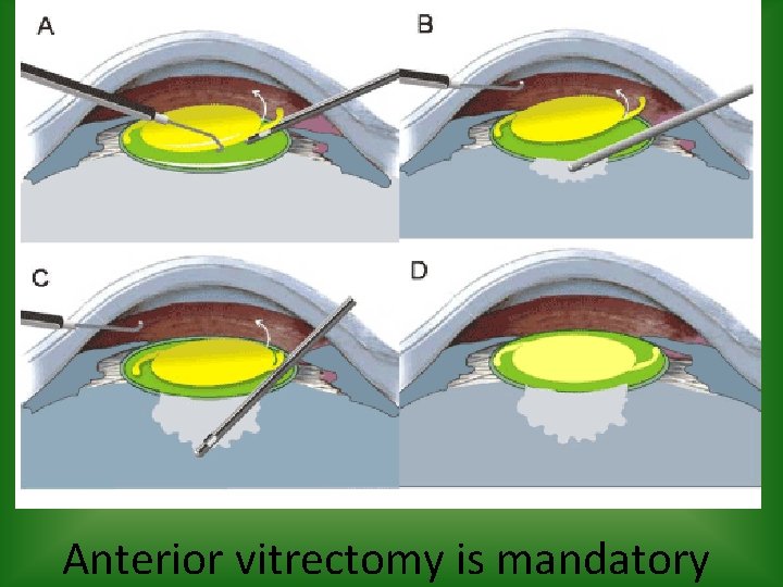 Anterior vitrectomy is mandatory 