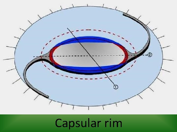 Capsular rim 
