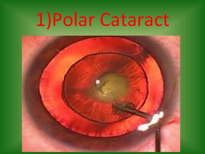1)Polar Cataract 