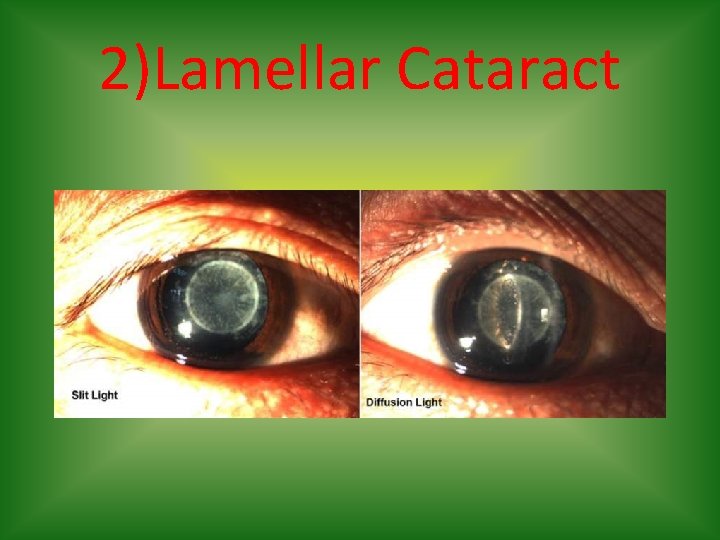 2)Lamellar Cataract 