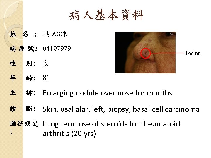 病人基本資料 姓 名 : 洪陳O珠 病 歷 號: 04107979 Lesion 性 別: 女 年