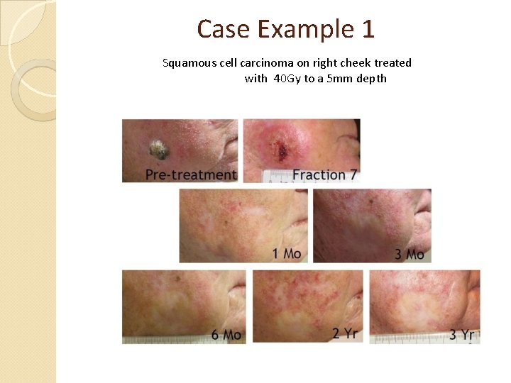 Case Example 1 Squamous cell carcinoma on right cheek treated with 40 Gy to