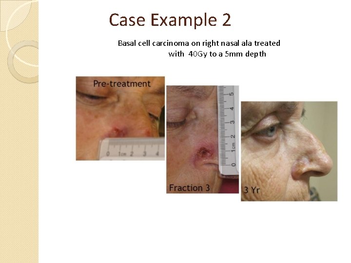 Case Example 2 Basal cell carcinoma on right nasal ala treated with 40 Gy