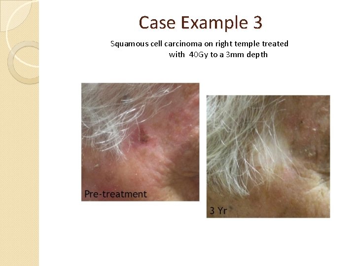 Case Example 3 Squamous cell carcinoma on right temple treated with 40 Gy to