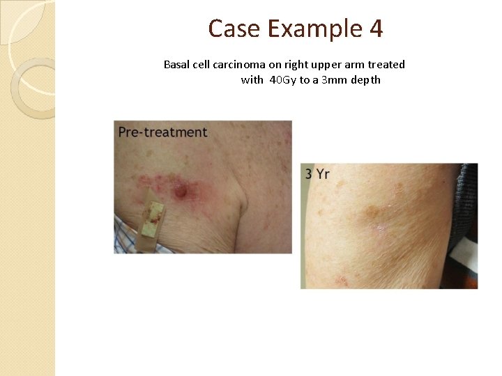 Case Example 4 Basal cell carcinoma on right upper arm treated with 40 Gy