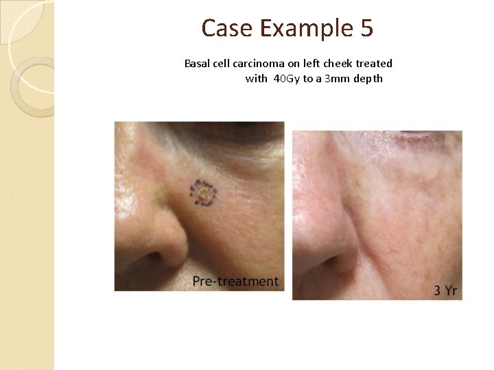 Case Example 5 Basal cell carcinoma on left cheek treated with 40 Gy to