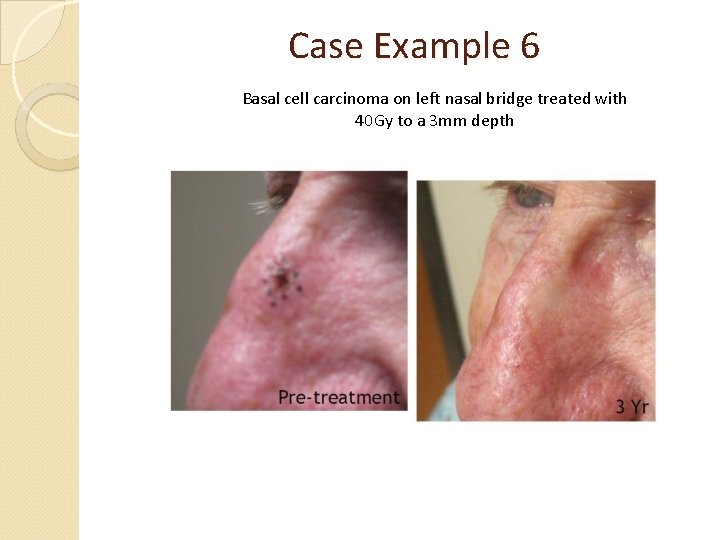 Case Example 6 Basal cell carcinoma on left nasal bridge treated with 40 Gy