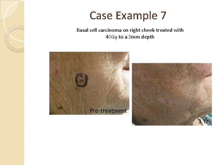 Case Example 7 Basal cell carcinoma on right cheek treated with 40 Gy to