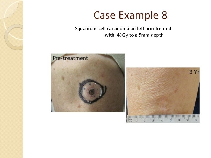 Case Example 8 Squamous cell carcinoma on left arm treated with 40 Gy to