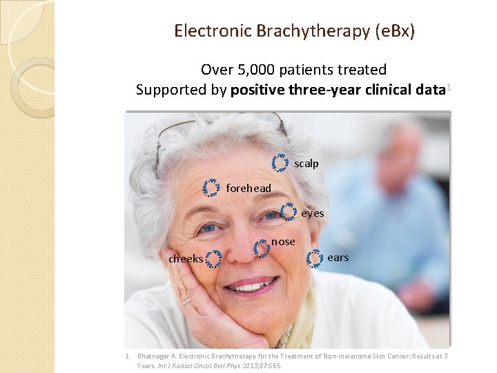 Electronic Brachytherapy (e. Bx) Over 5, 000 patients treated Supported by positive three-year clinical