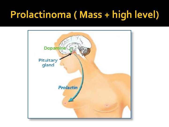 Prolactinoma ( Mass + high level) 