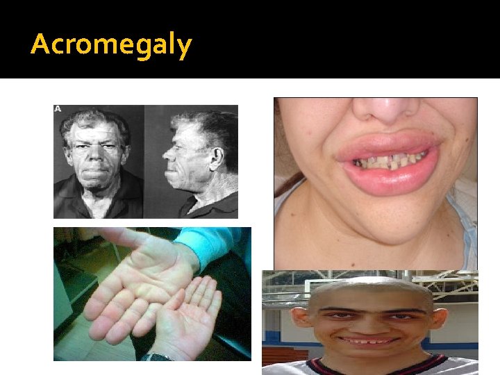 Acromegaly 