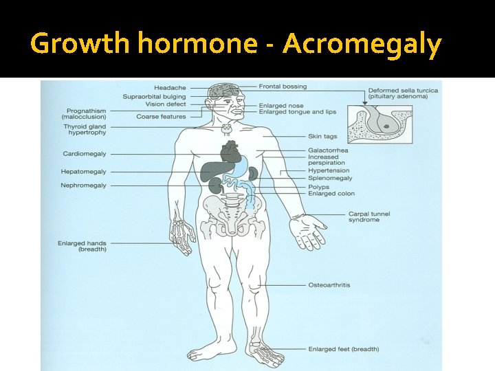 Growth hormone - Acromegaly 